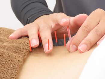 竹ノ塚喜楽鍼灸接骨院/施術風景（鍼施術）