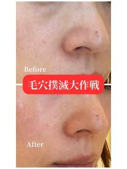 イリゼ(iriser)/プラズマフェイシャル