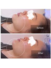 ウィズ ユー ビューティ(with U beauty)/一気に小顔