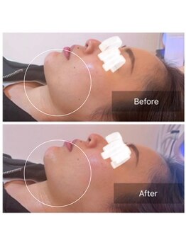 ウィズ ユー ビューティ(with U beauty)/一気に小顔