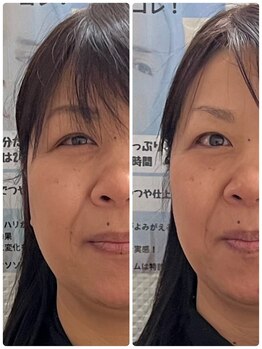 ジェーピーユキノ(jp.yukino)/小顔コルギ・艶肌