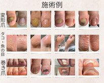 フットメンテ 巻き爪矯正センター 南浦和