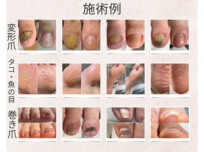 フットメンテ 巻き爪矯正センター 南浦和の写真
