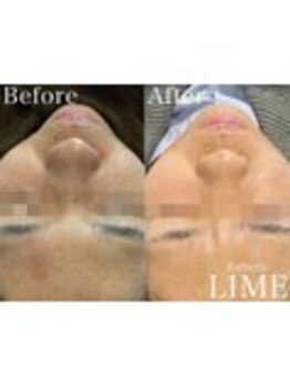 ベル 赤羽(Belle)/ハーブピーリング｜ニキビケア