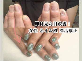 ネイル風 深爪矯正