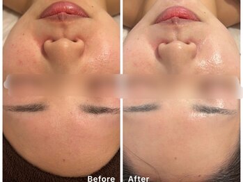 サロンアルーナ(Salon a Luna)/剥離しないハーブピーリング