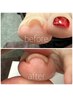 【FOOT巻き爪改善】痛みを和らげながらジェルネイル◎¥12100→¥11100