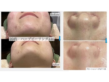 チャンティック (CANTIK)/大人気のハーブピーリング