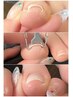 【担当アキ】【今だけ限定価格】巻き爪ケア 1本8000円→5000円!【40分】