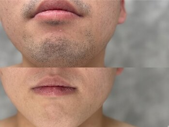シュシュ(chouchou)の写真/【男性の身だしなみ】毎日のヒゲ剃りから解放◎清潔感のある好印象な素肌へ導くプロのケアをご提供します！