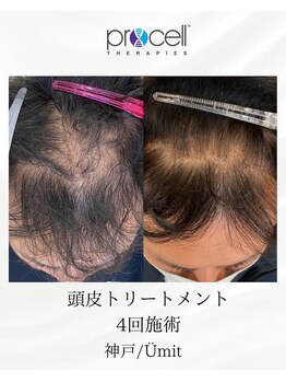 ユミト(Umit)/プロセルスカルプ
