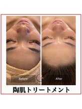 ラナン パラフューズ(Ranun's PARAFUSE.)/陶肌ビフォーアフター（2）