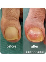 上高田つつじ整体院/巻き爪　ネイルケア　例