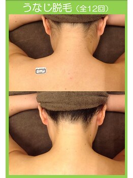 スターポルト(Star-Porte)/襟足脱毛