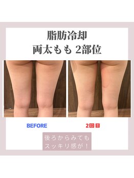 クリーンビューティーメディカルサロン(CLEAN BEAUTY Medical Salon)/脂肪冷却　両太もも