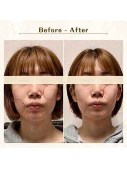 アレイズ/小顔矯正コース