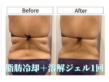 パラアモール(Paraamor)/脂肪冷却1回のビフォーアフター