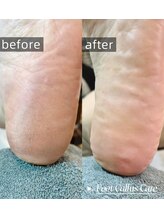 ラブリスタル(Loverystal)/フット角質除去