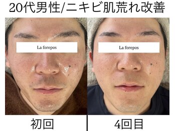 ラ フォルポ 恵比寿(La forepos)/ニキビケア/ハーブピーリング