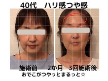 エンジェルエッグ/◆顔全体的に引き上がってます