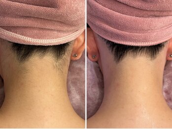 ビューティービレッジ(Beauty village)の写真/【"うなじ美人"首が長くみえる!】意外と見られるうなじや背中のムダ毛をケアしてアップスタイルも快適に♪