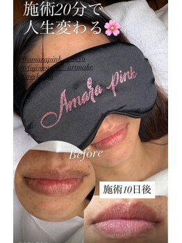 フジモトサロン 那覇おもろまち店(fujimotoサロン)/アマラピンク施術10日後