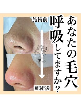 ピュール 鯖江店(PUR)/毛穴/毛穴ケア/毛穴洗浄