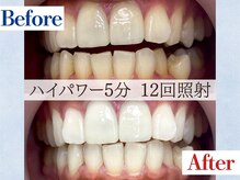 LBSホワイトニング 吉祥寺店/ホワイトニングビフォーアフター