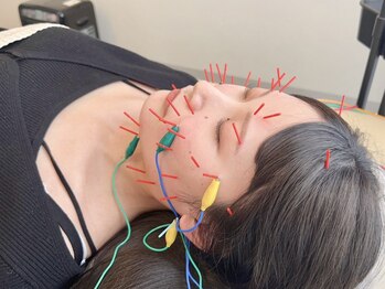 アウン(aum)の写真/美容鍼×整体でほうれい線・たるみ・肌質を根本改善！aum独自メソット"美容鍼小顔矯正術″で圧倒的効果を◎