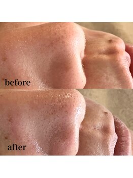 トキイロ 高宮(tokiiro)/気になる角栓ごっそり!