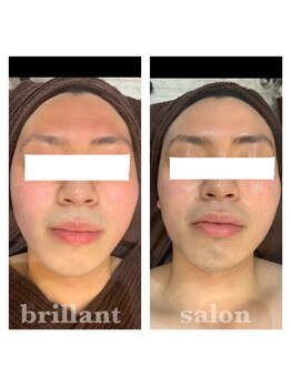 ブレリアントサロン 池袋店(brillant salon)の写真/肌育始めませんか?お顔の汚れをまるごとお掃除◎当店オリジナル毛穴洗浄 (ハイドラフェイシャル) ¥9900人気