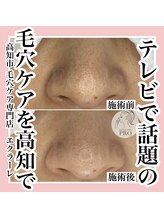 エクラーレ(Eclale)/【毛穴ケア】症例