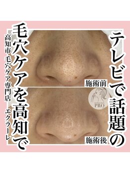エクラーレ(Eclale)/【毛穴ケア】症例