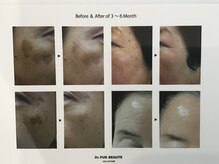 ピュール(pure)/純粋レチノールピールの効果