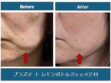 エステサロン☆さいとうの雰囲気（口ヨコのポニョにもレモンボトル導入ですっきり！肌ツヤ効果も）