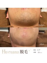 フルアナ(Hu ruana)/ヒゲ脱毛