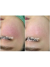 モイ(moi.)/◆漢方ハーブピーリング◆