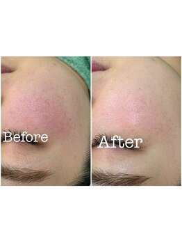 モイ(moi.)/◆漢方ハーブピーリング◆