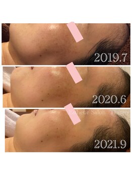 エステティックサロンティエリー/オーガニックプレミアムパウダー