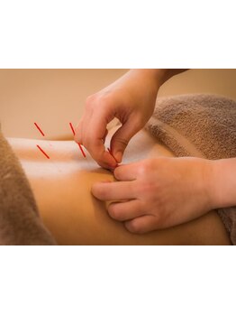 鍼灸施術を受けたい