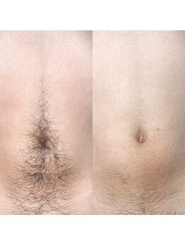リル(RILU)/腹【脱毛】男性(before・after)