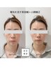 【人気No.1】痩せた？と聞かれるスッキリ小顔へ◎ 美容鍼＋小顔(首肩ケア付)