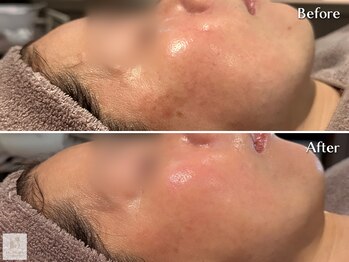 サロン ド エス アオヤマ(SALON DE S AOYAMA)の写真/青山・外苑前で本場韓国肌管理。ララピールで毛穴・ニキビ改善。水光肌を叶える最新の肌育エステ。