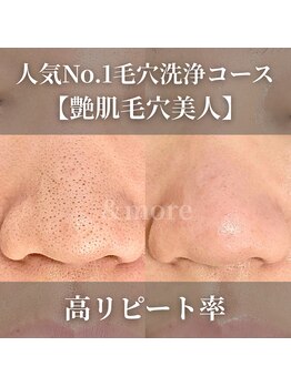 アンドモア(&more)の写真/長年の毛穴の黒ずみ/詰まり/ザラつきを徹底ケア。『もっと早く来れば良かった』『自分の鼻じゃないみたい』