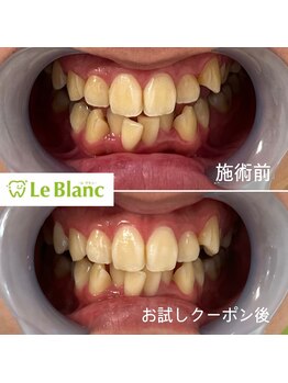 ルブラン 奈良店(Le Blanc)/初回の2回照射!