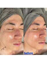 ダリア(Dahlia)/ハーブピーリング【メンズ】