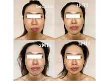 エクレクティック(ECLECTIC)/テラボーラー/小顔/ほうれい線/