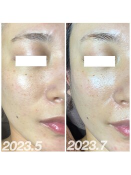 ココ(COCO)/ハーブピーリング/REVI/高知