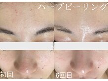 サロンドジェシカ(salon de Jessica)/ハーブピーリング