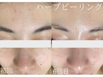 サロンドジェシカ(salon de Jessica)/ハーブピーリング